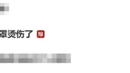 杨幂脸被蒸汽眼罩烫伤了：大家使用时要小心