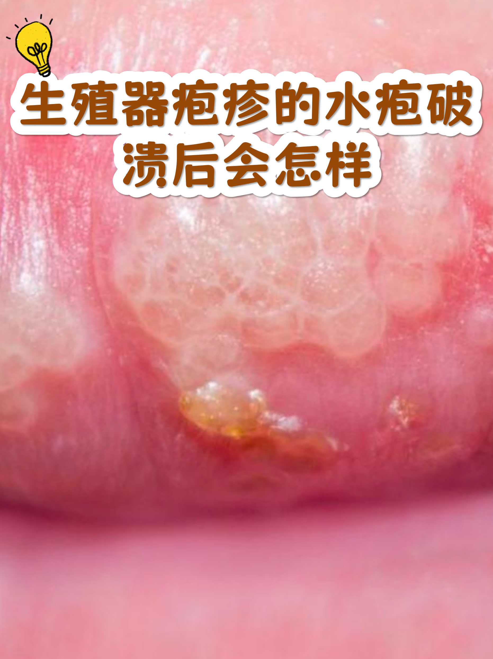 美国疱疹科技前沿,美国生产带状疱疹疫苗的主要有哪几个厂家 美国疱疹科技前沿,美国生产带状疱疹疫苗的主要有哪几个厂家