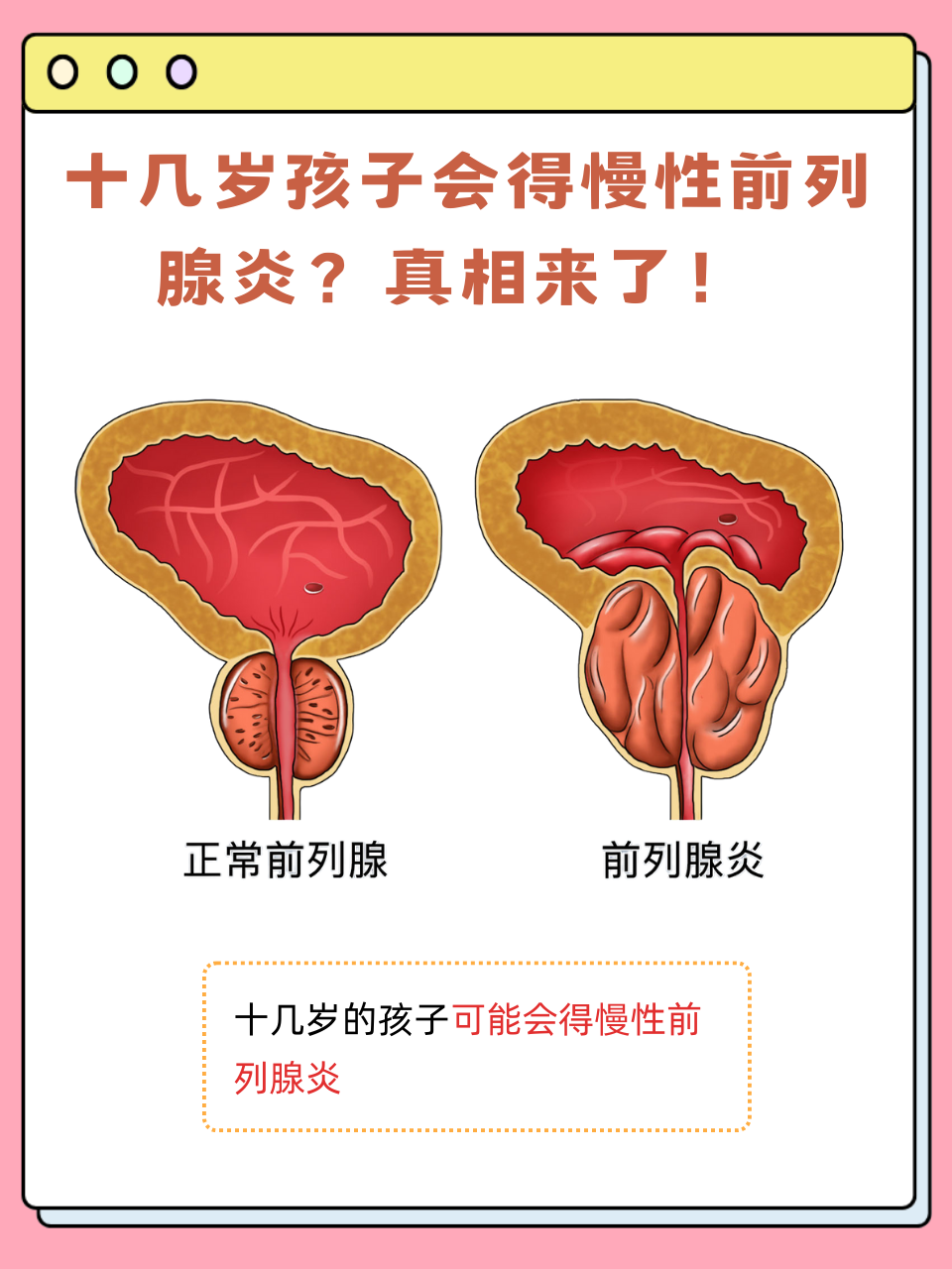 前列腺炎科技前沿,前列腺炎医学攻克进展 前列腺炎科技前沿,前列腺炎医学攻克进展