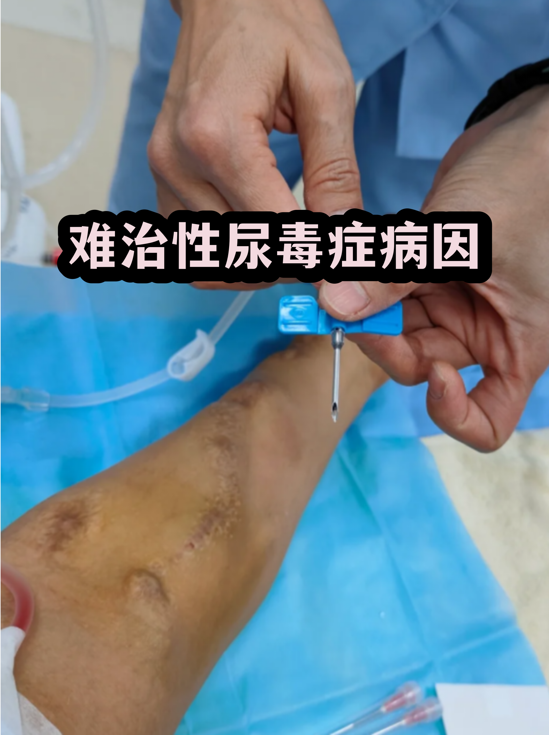治尿毒症的科技前沿,尿毒症的替代治疗有哪三个 治尿毒症的科技前沿,尿毒症的替代治疗有哪三个