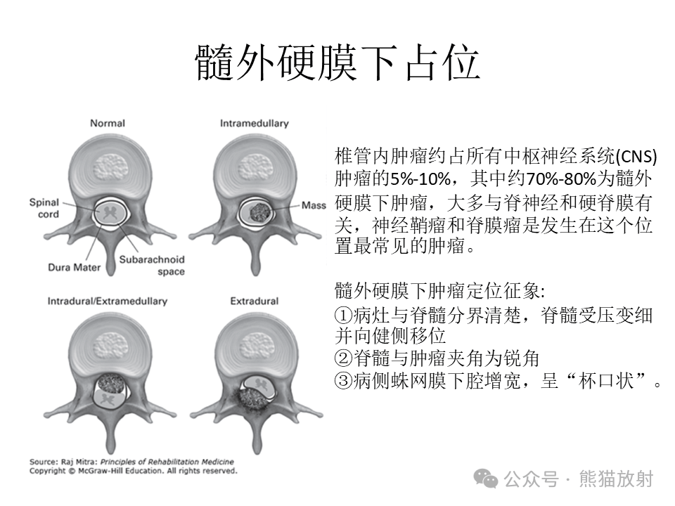 脊索瘤的科技前沿,脊索瘤的病理形态特点 脊索瘤的科技前沿,脊索瘤的病理形态特点