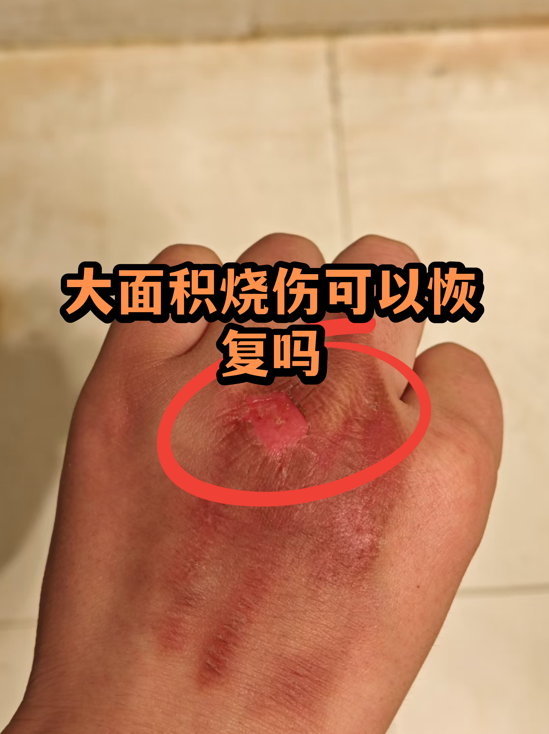 烧伤恢复科技前沿,烧伤恢复最好的案例