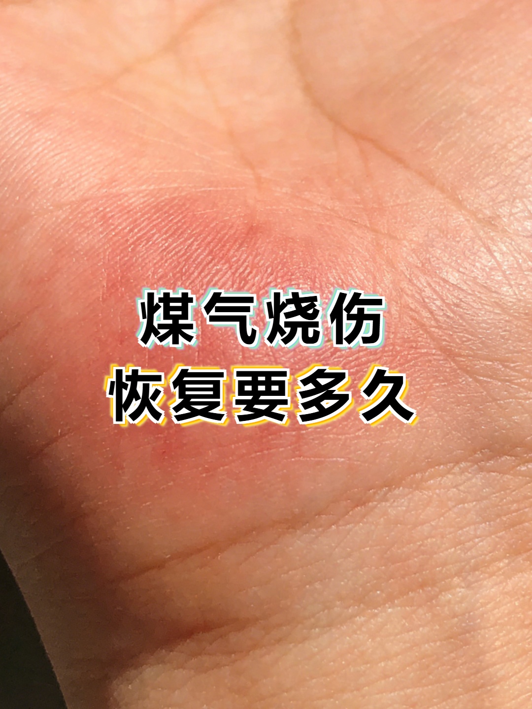 烧伤恢复科技前沿,烧伤恢复最好的案例 烧伤恢复科技前沿,烧伤恢复最好的案例