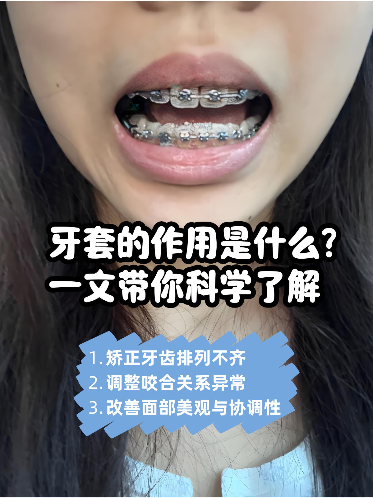 牙套的科技前沿是什么,牙套的科技前沿是什么样的 牙套的科技前沿是什么,牙套的科技前沿是什么样的