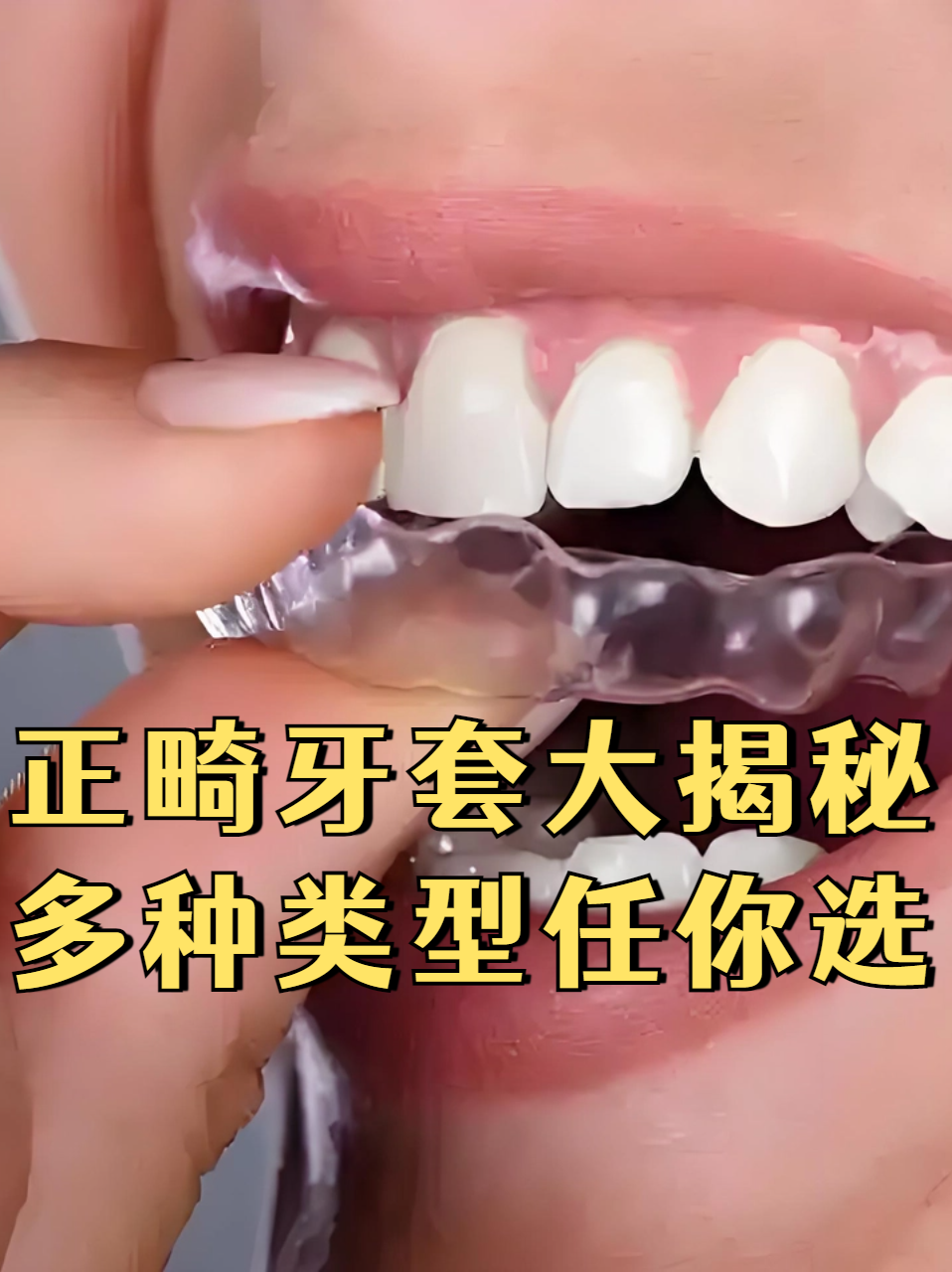 牙套的科技前沿是什么,牙套的科技前沿是什么样的 牙套的科技前沿是什么,牙套的科技前沿是什么样的