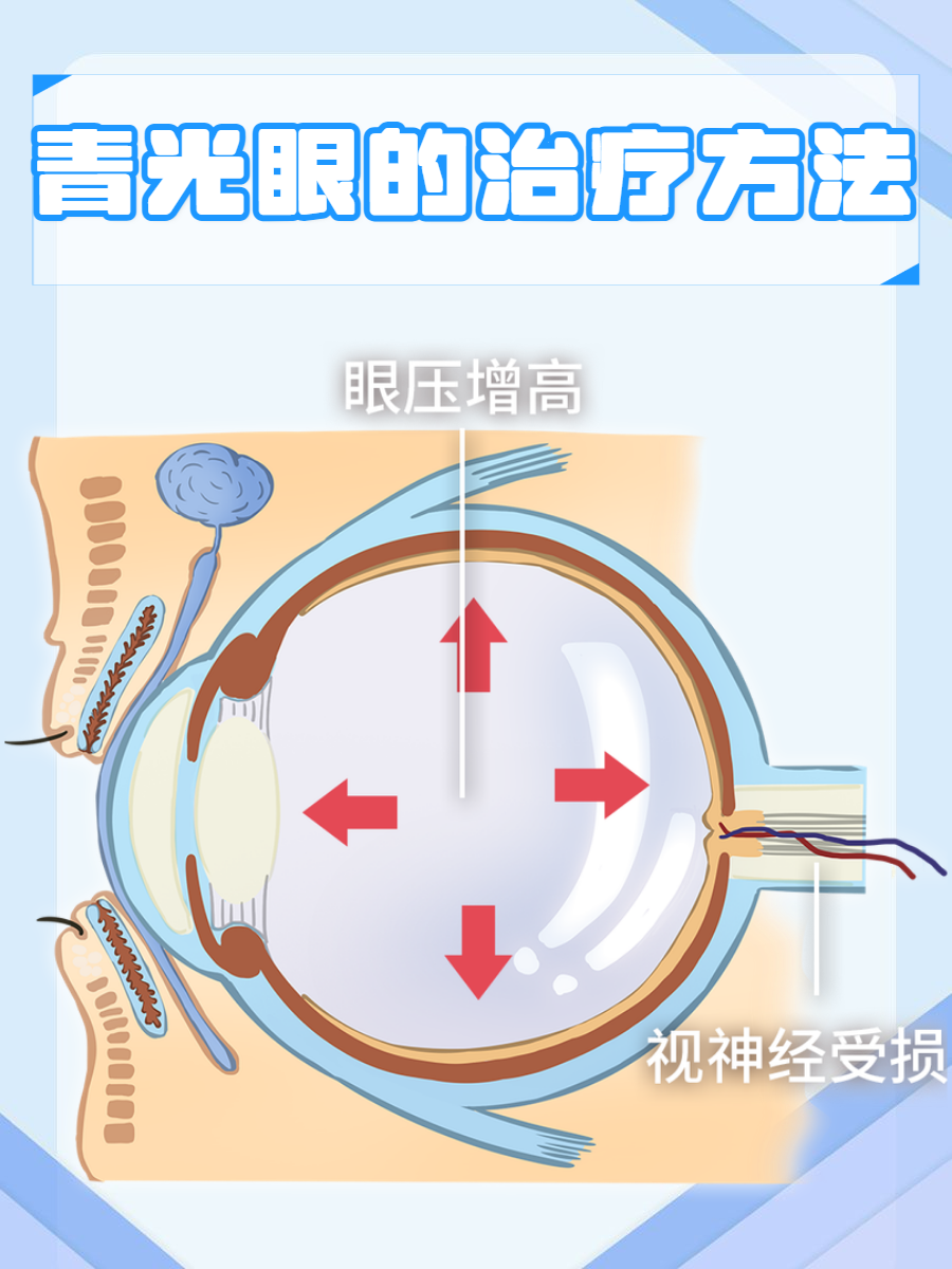 青光眼最新科技前沿,青光眼研究最新突破进展