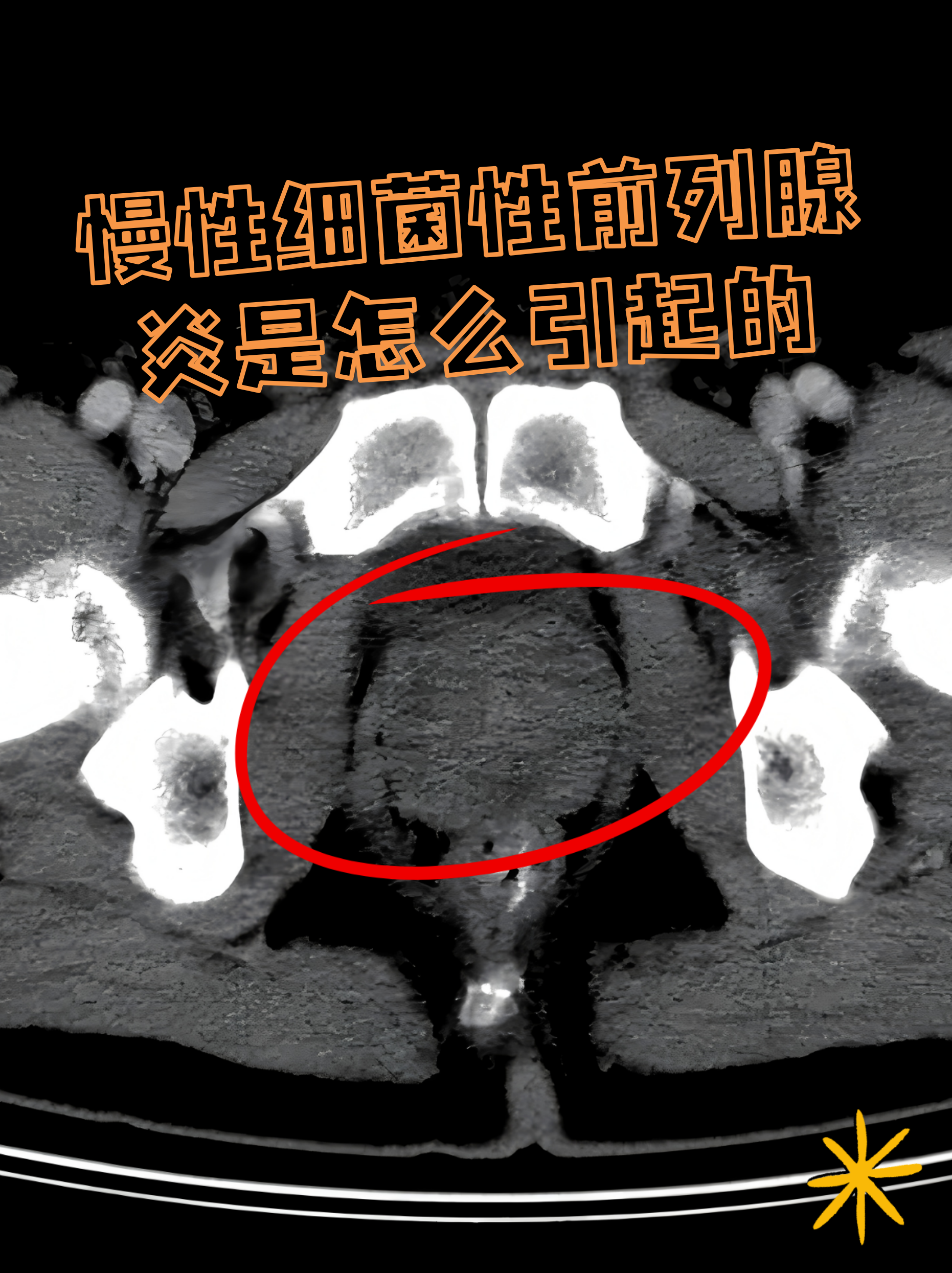 科技前沿前列腺炎,前列腺炎最新研究突破 科技前沿前列腺炎,前列腺炎最新研究突破
