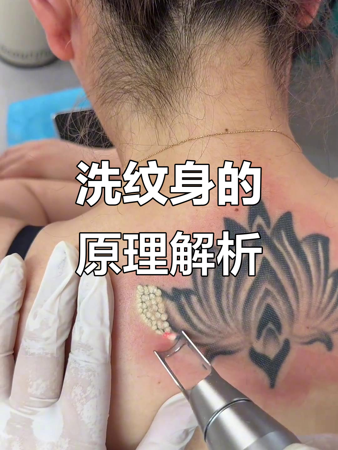 小面积纹身怎么去除