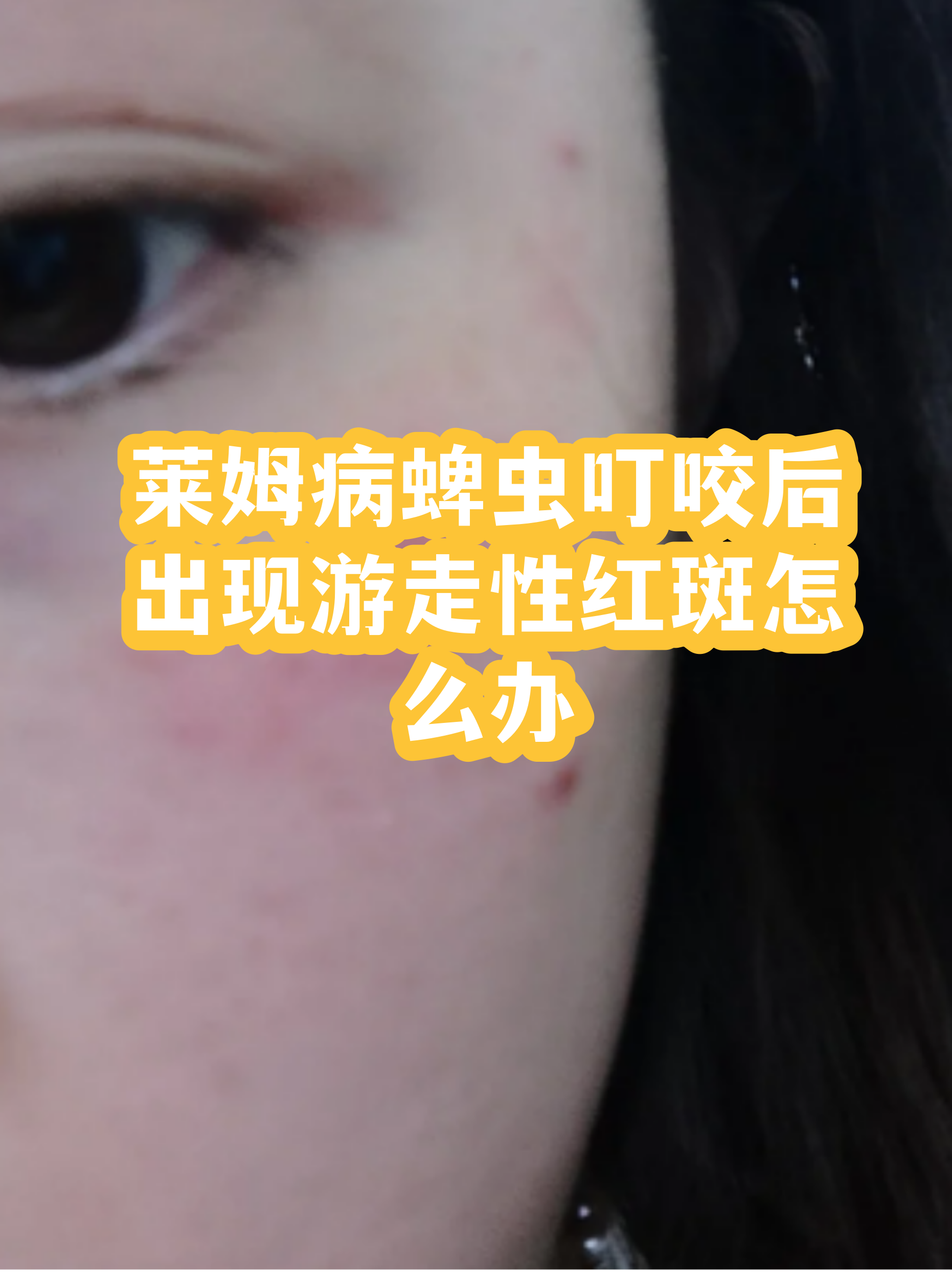 蜱虫咬人怎么弄出来视频