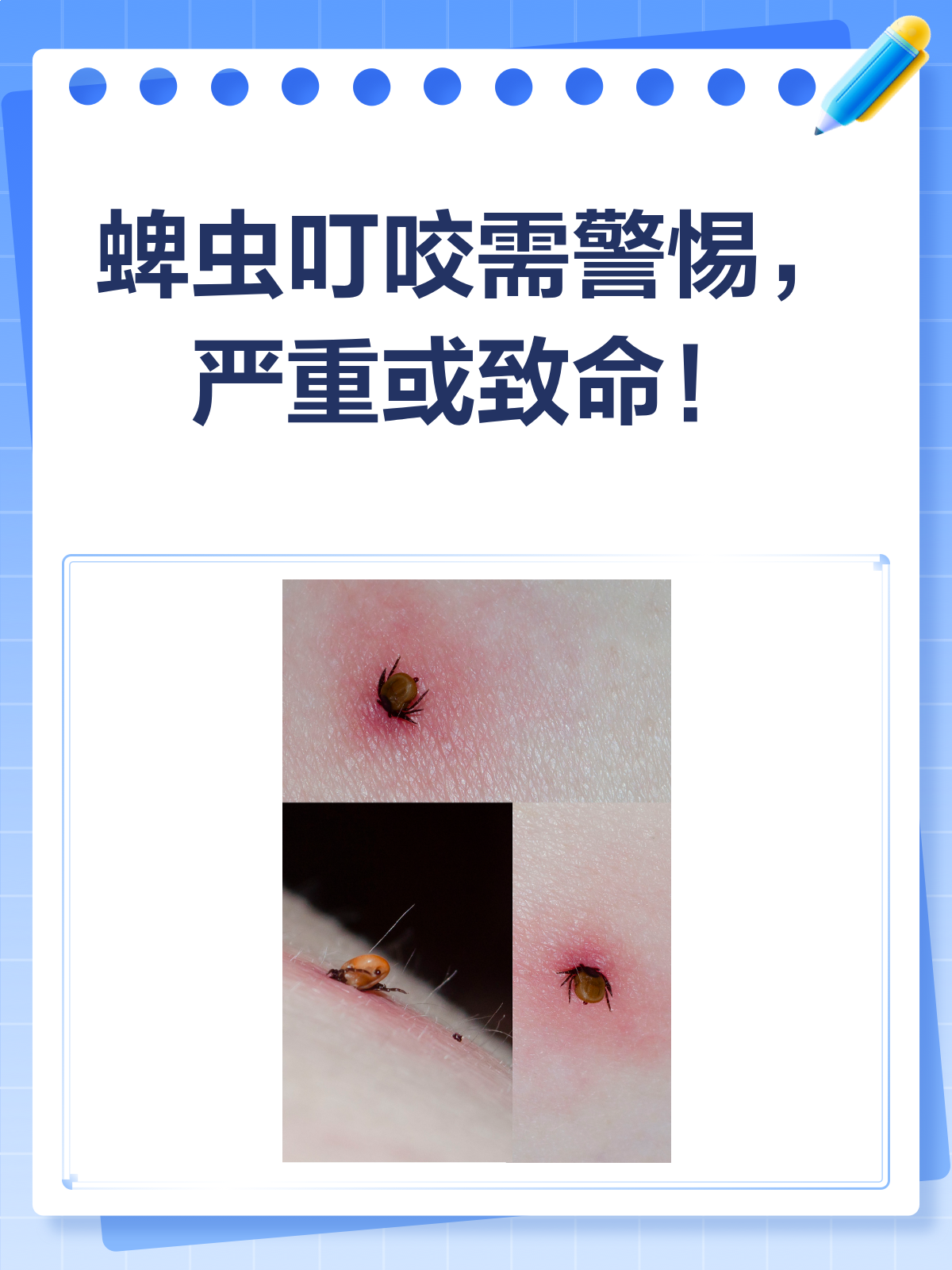 蜱虫咬人怎么弄出来视频 蜱虫咬人怎么弄出来视频