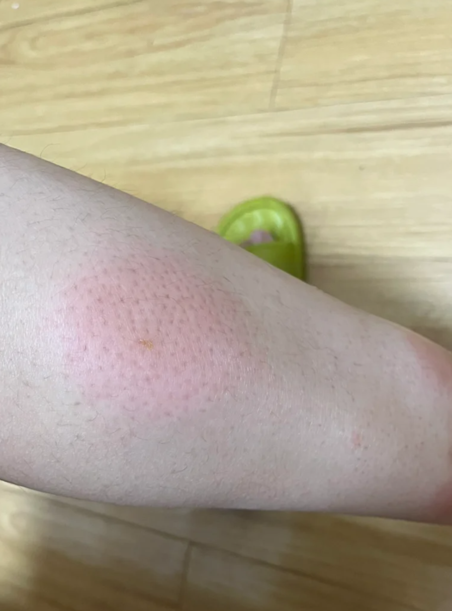 蜱虫咬伤后遗症是多久