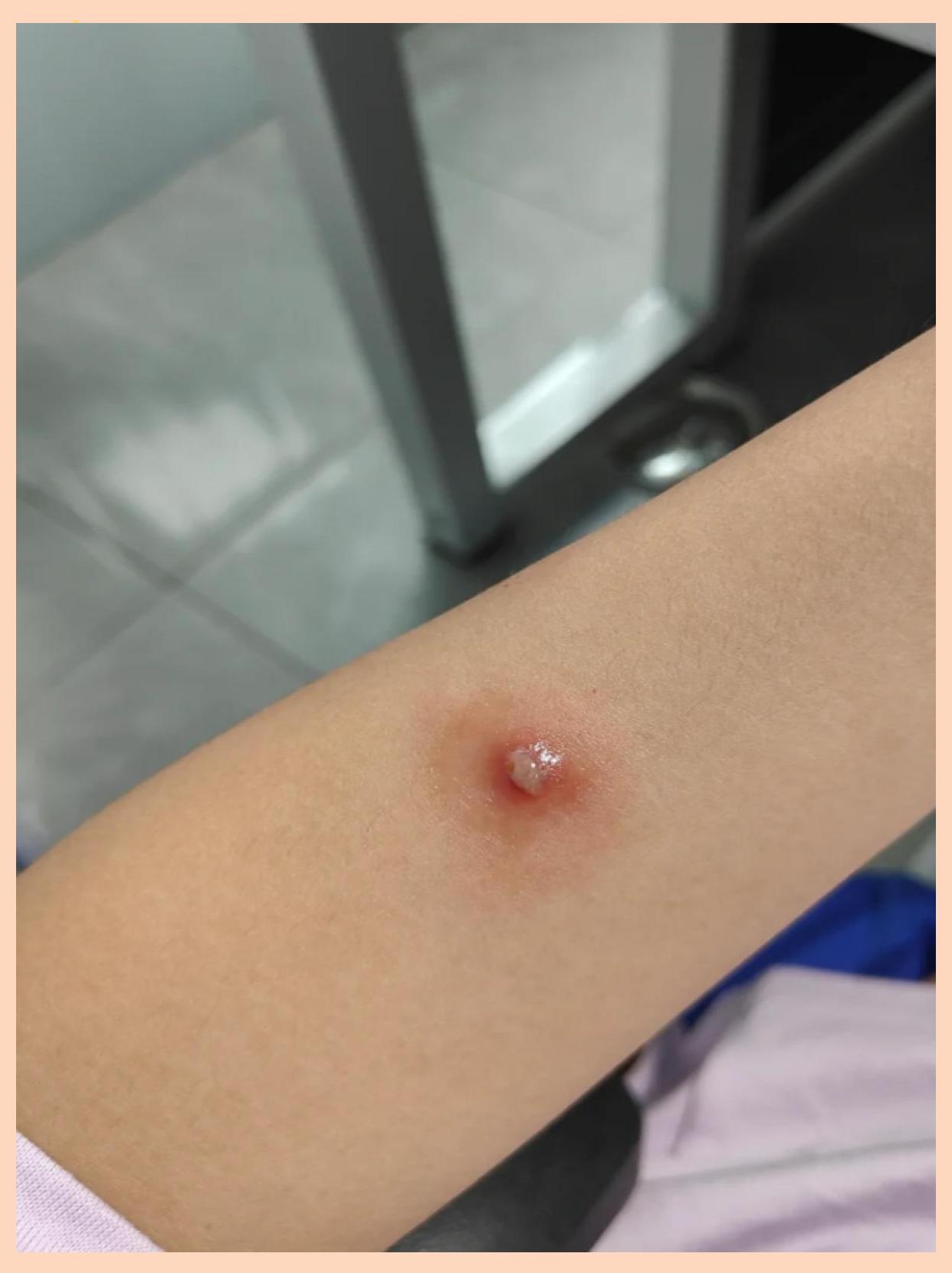 蜱虫咬伤伤口什么样