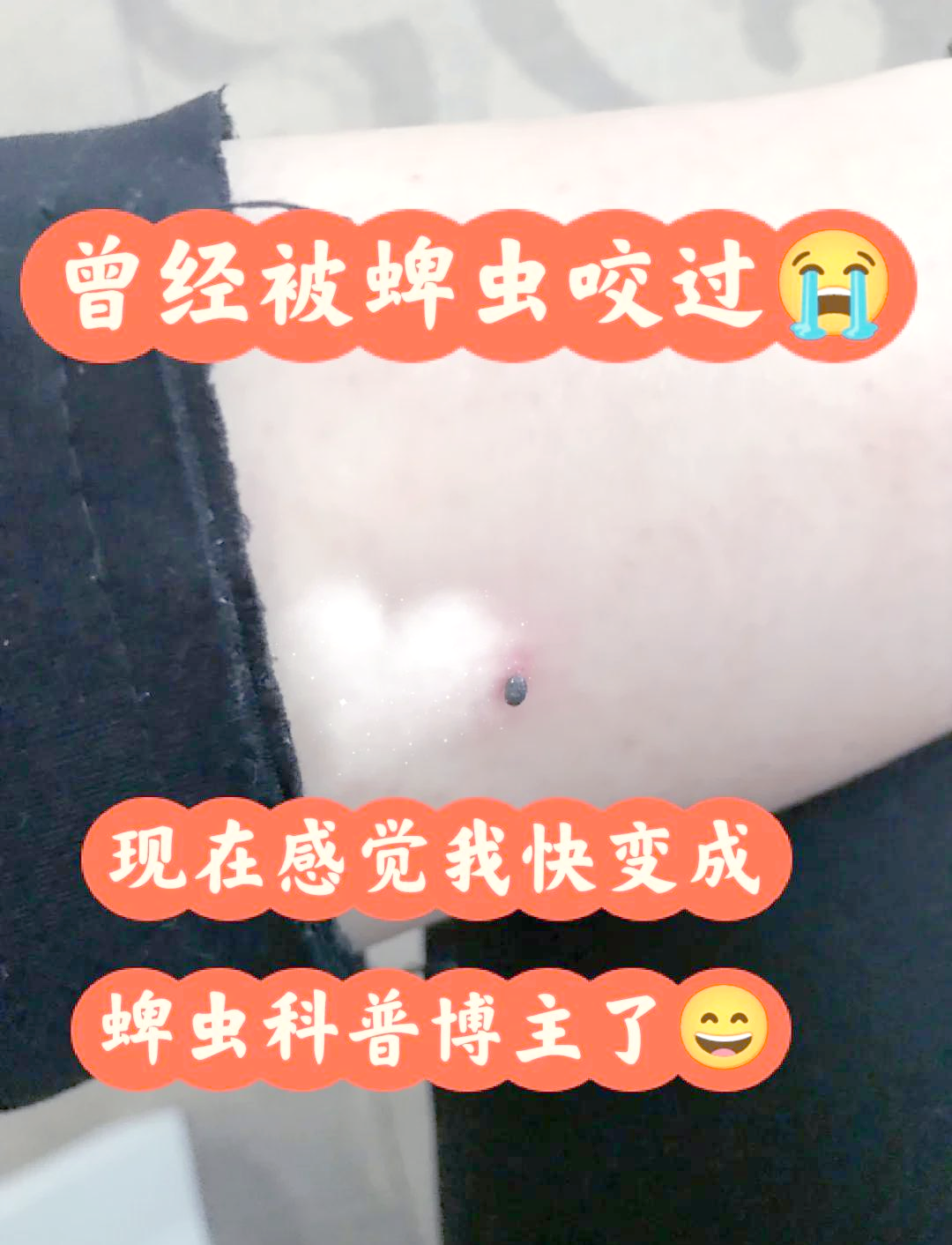 蜱虫咬伤伤口什么样 蜱虫咬伤伤口什么样